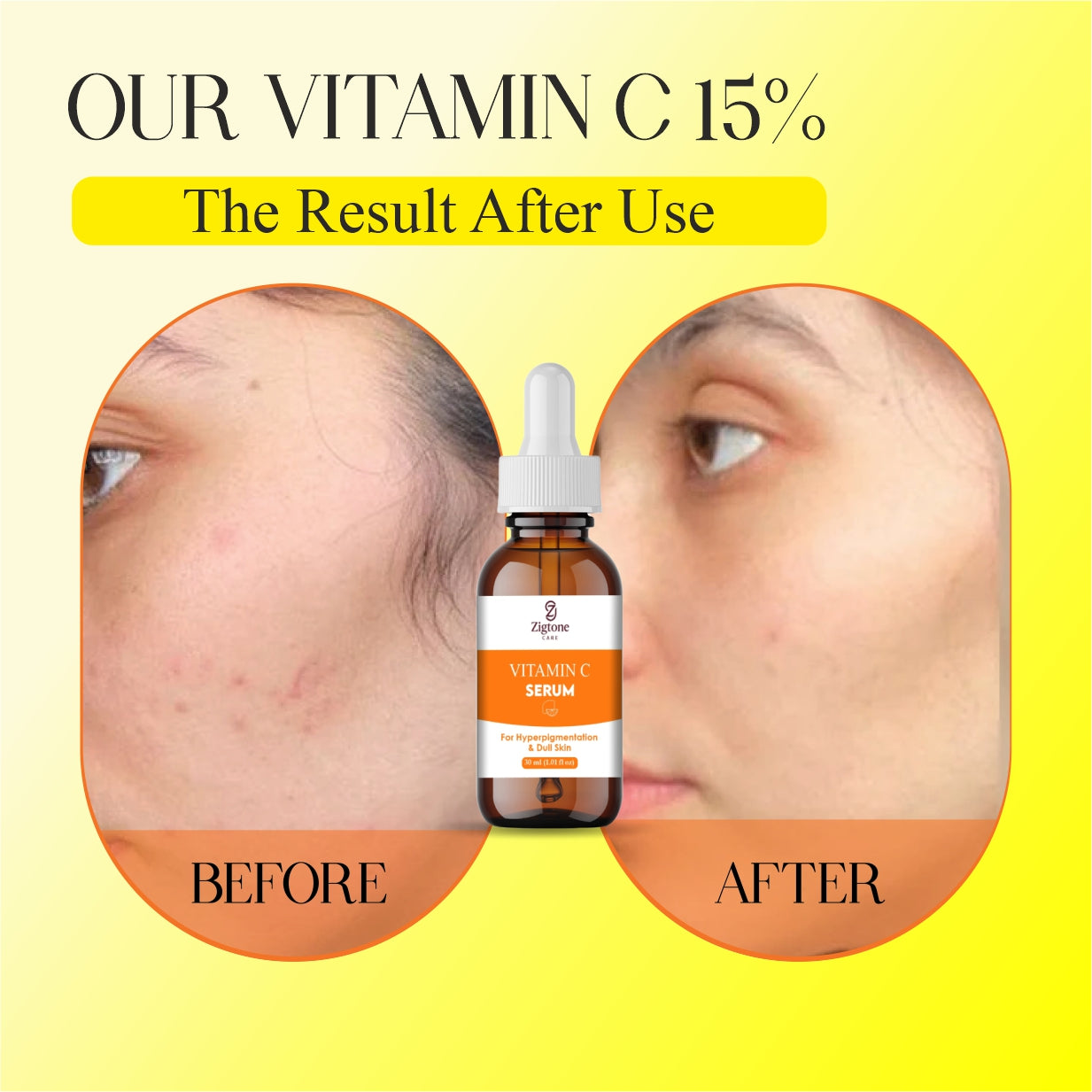 Zigtone Care Vitamin C Serum for Hyperpigmentation and Dull Skin, Brightening Face Treatment, 30ml (1.01 fl oz), Amber Glass Bottle with Dropper